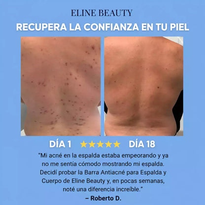 Barra Antiacné para Espalda y Cuerpo™