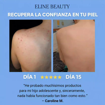 Barra Antiacné para Espalda y Cuerpo™